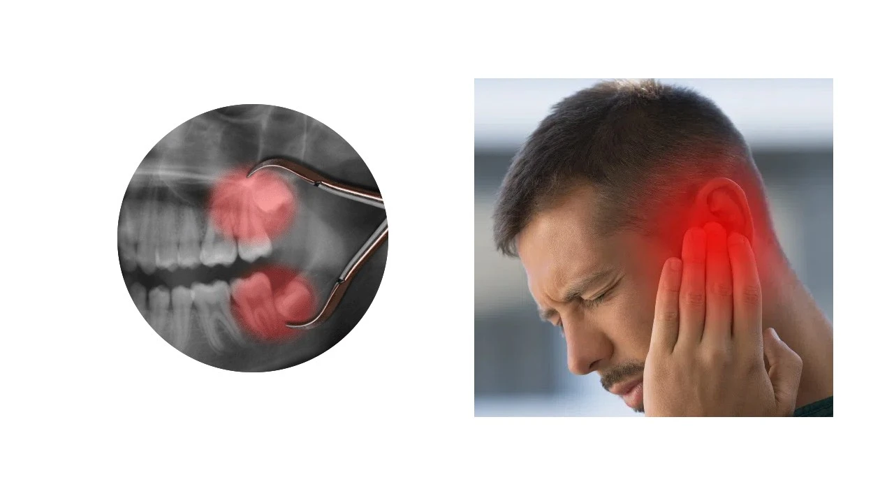 Ear Pain After Wisdom Teeth Removal