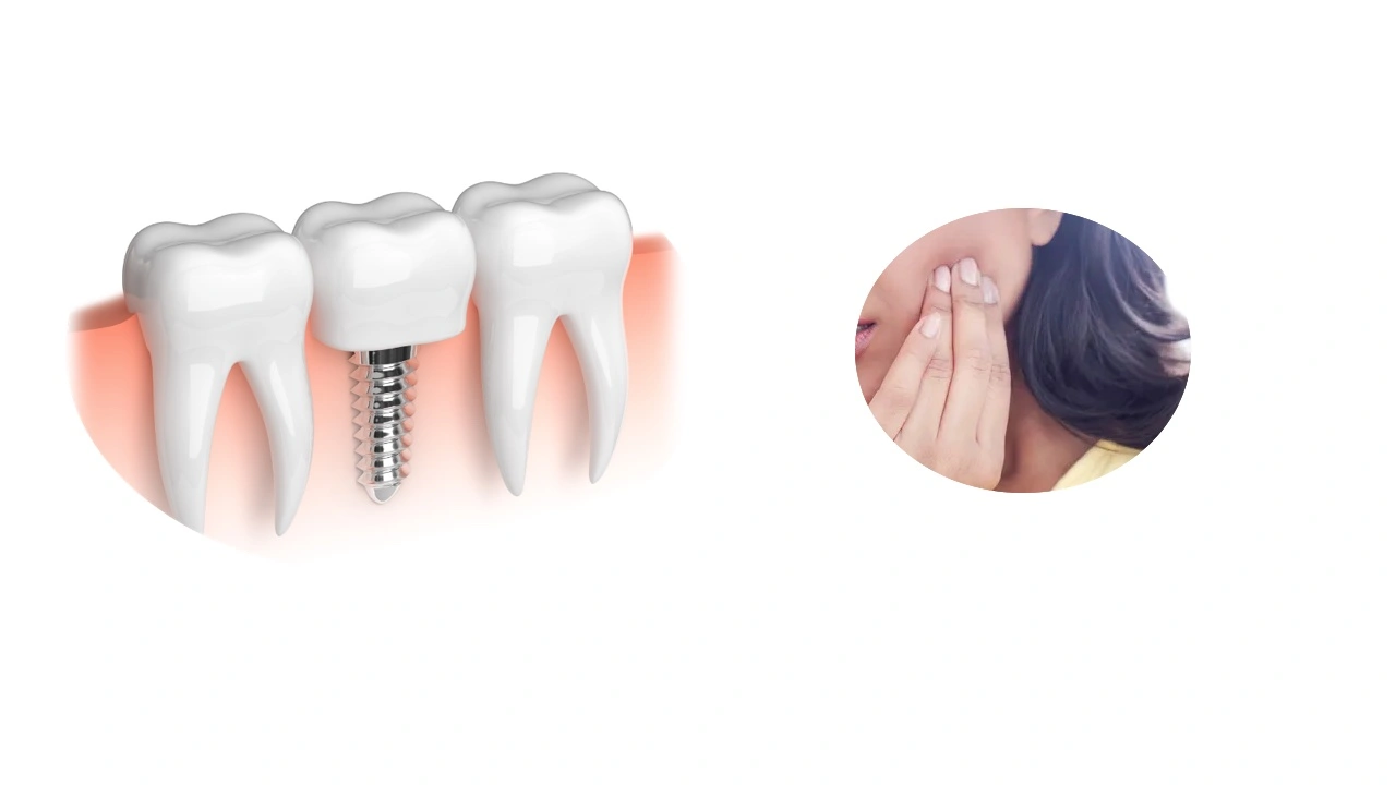 How to Relieve Pain from Dental Implants