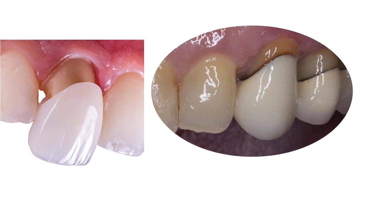 Tooth Pain Under Crown Comes and Goes